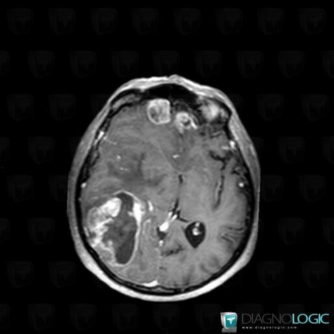 Metastasis, Cerebral hemispheres, MRI