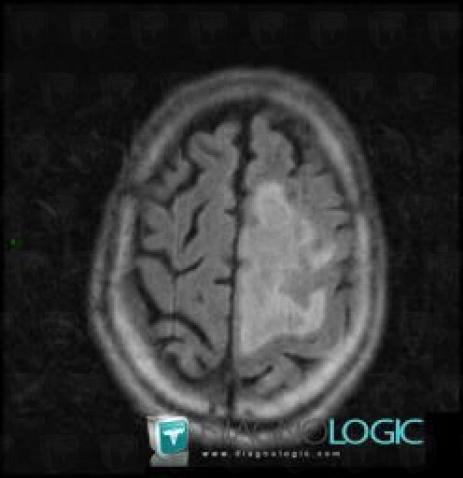 Metastasis, Cerebral hemispheres, MRI