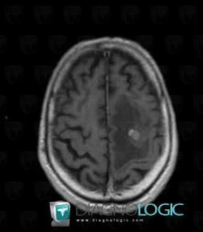 Metastasis, Cerebral hemispheres, MRI