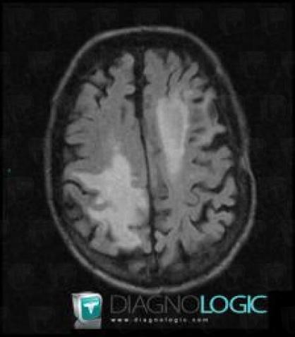 Metastasis, Cerebral hemispheres, MRI