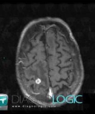 Metastasis, Cerebral hemispheres, MRI