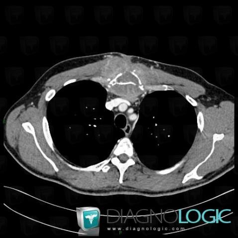 Metastasis, Chest wall, CT