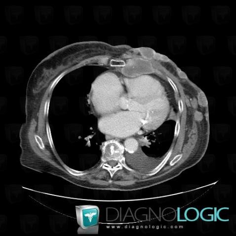 Metastasis, Chest wall, CT