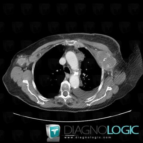 Metastasis, Chest wall, CT