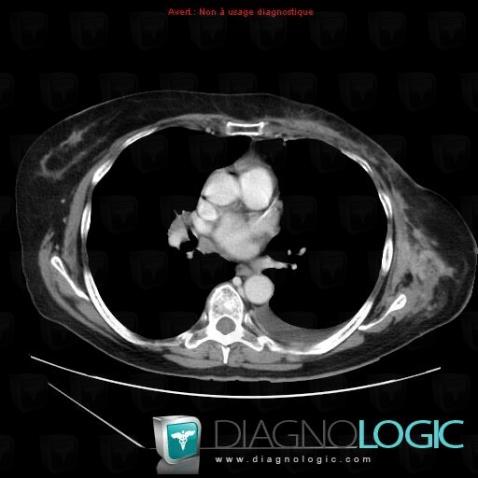 Metastasis, Chest wall, CT