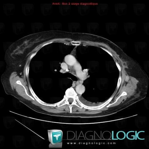 Metastasis, Chest wall, CT