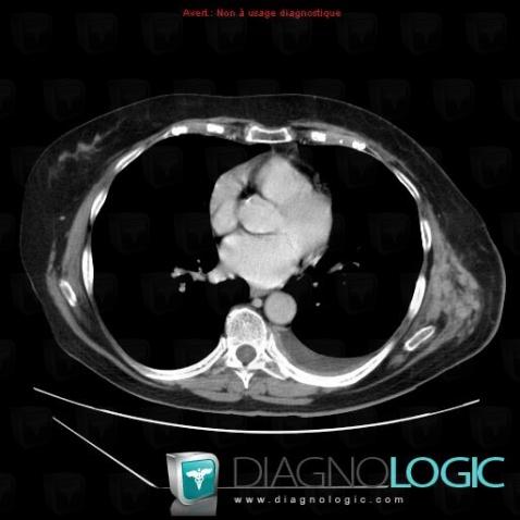 Metastasis, Chest wall, CT