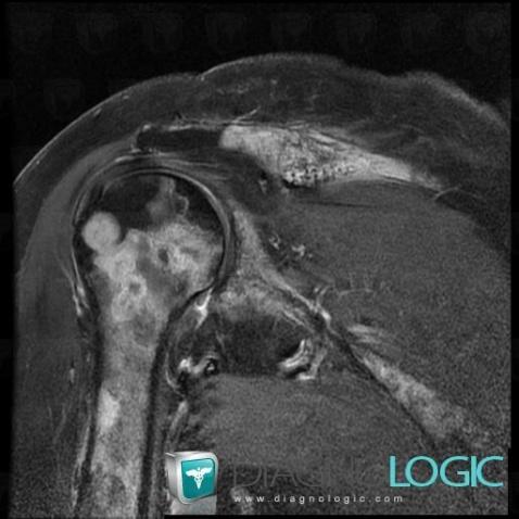 Metastasis, Clavicle, Humerus - Proximal part, MRI