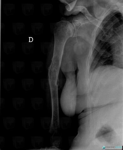 Metastasis, Clavicle, Humerus - Proximal part, X rays