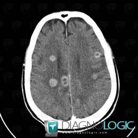 Metastasis, Cortico subcortical region, Cerebral hemispheres, CT