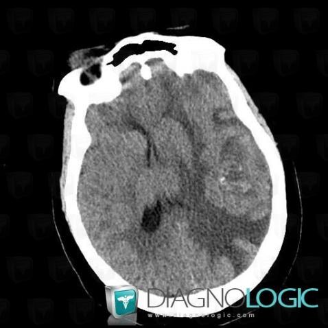 Metastasis, Cortico subcortical region, Cerebral hemispheres, CT