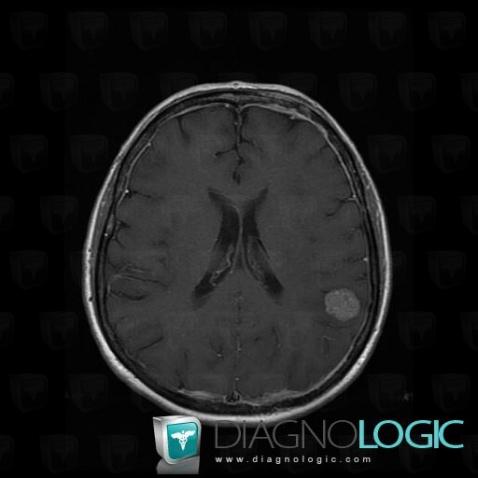 Metastasis, Cortico subcortical region, Cerebral hemispheres, MRI