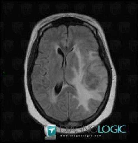 Metastasis, Cortico subcortical region, Cerebral hemispheres, MRI