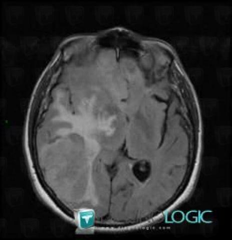 Metastasis, Cortico subcortical region, Cerebral hemispheres, MRI