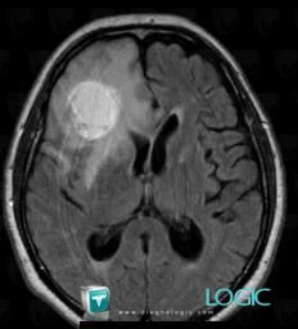 Metastasis, Cortico subcortical region, MRI