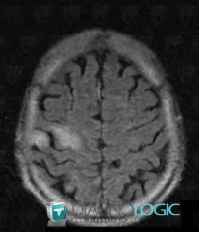 Metastasis, Cortico subcortical region, MRI