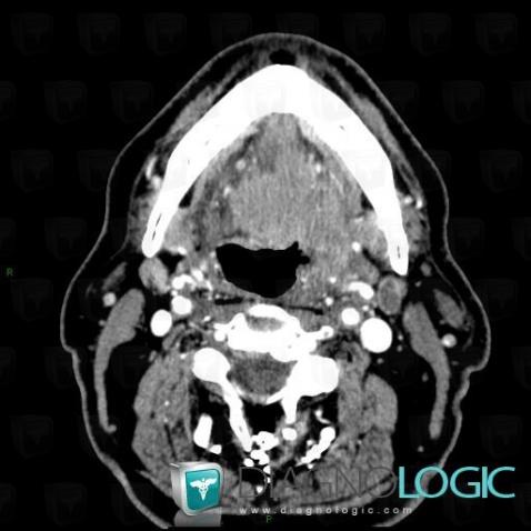 Metastasis, Deep facial spaces, CT