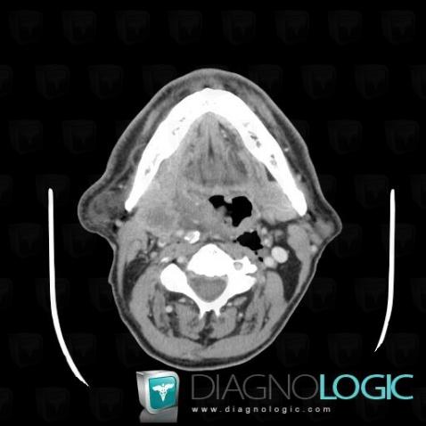 Metastasis, Deep facial spaces, CT