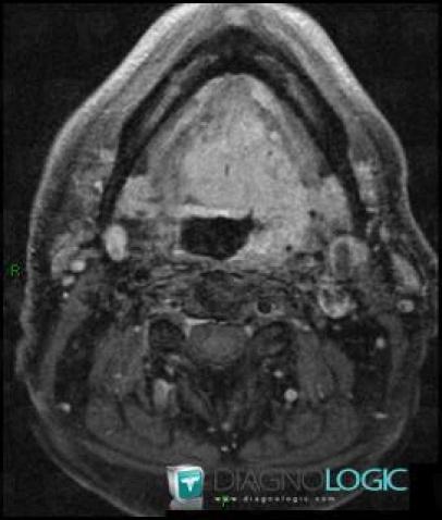 Metastasis, Deep facial spaces, MRI