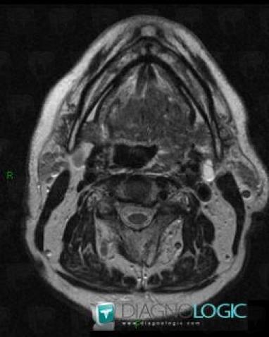 Metastasis, Deep facial spaces, MRI