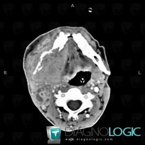 Metastasis, Deep neck spaces, CT