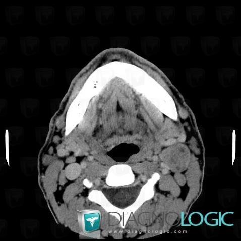 Metastasis, Deep neck spaces, CT