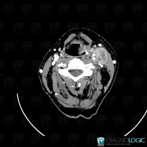 Metastasis, Deep neck spaces, CT