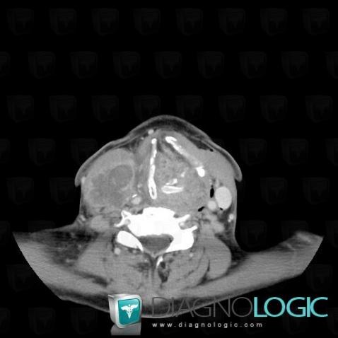 Metastasis, Deep neck spaces, CT