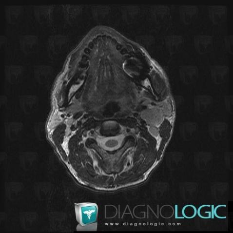 Metastasis, Deep neck spaces, MRI