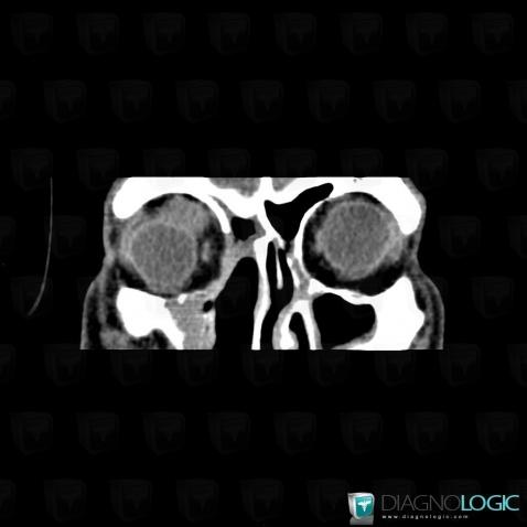 Metastasis, Eye, CT