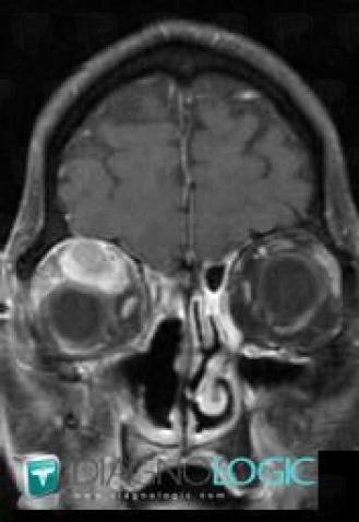 Metastasis, Eye, MRI