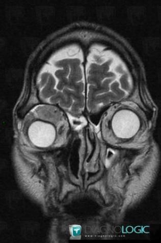 Metastasis, Eye, MRI