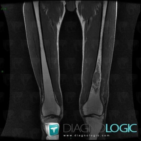 Metastasis, Femur - Distal part, MRI