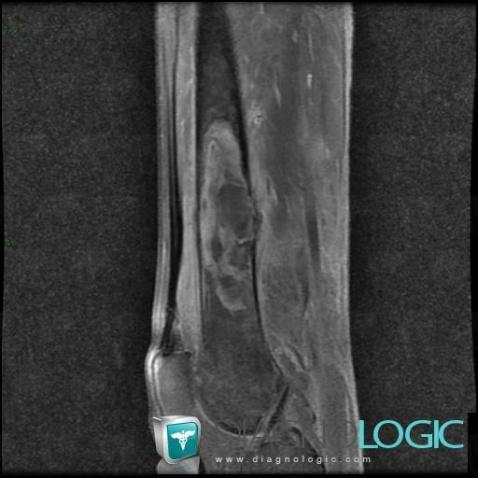 Metastasis, Femur - Distal part, MRI