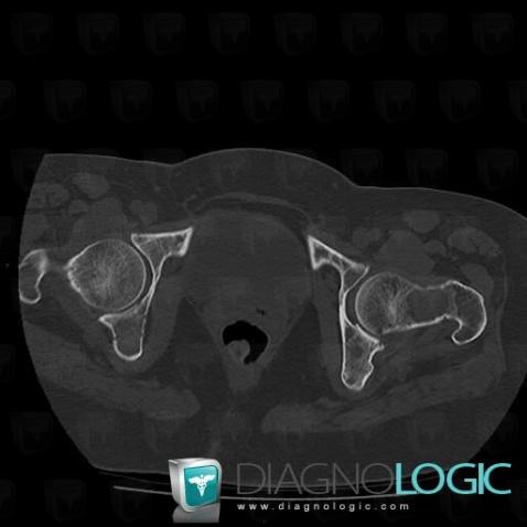 Metastasis, Femur - Proximal part, CT