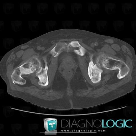 Metastasis, Femur - Proximal part, CT