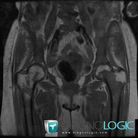 Metastasis, Femur - Proximal part, Femur - Mid part, MRI