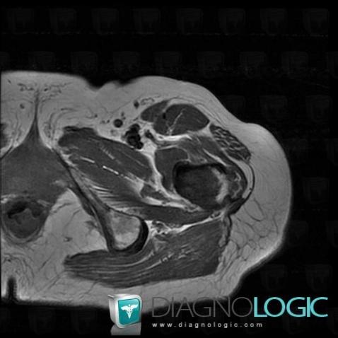 Metastasis, Femur - Proximal part, MRI