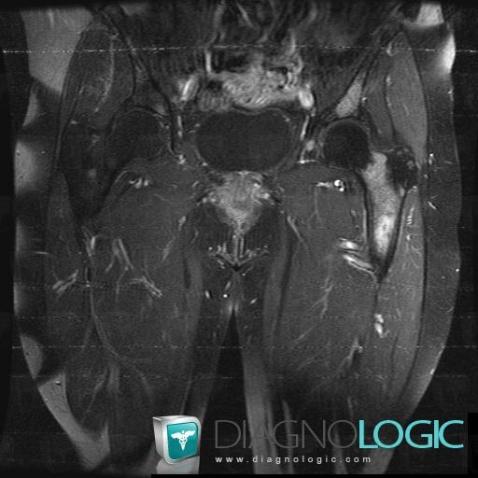 Metastasis, Femur - Proximal part, MRI