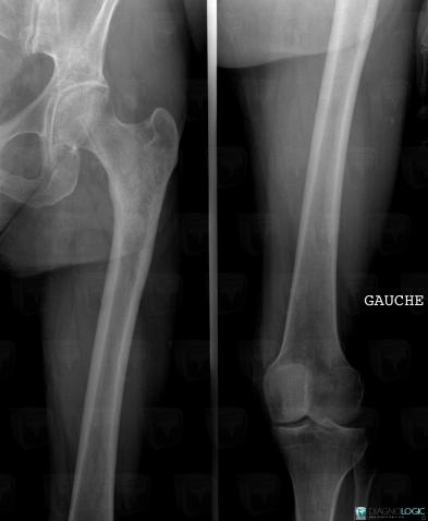 Metastasis, Femur - Proximal part, X rays