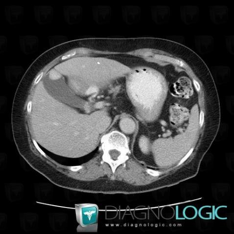 Metastasis, Gallbladder, CT