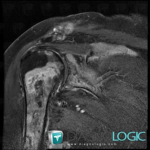 Metastasis, Humerus - Proximal part, MRI