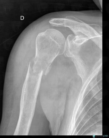 Radiology case : Metastasis (X rays) - Diagnologic