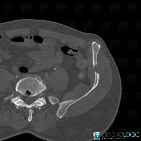 Metastasis, Ilium, CT
