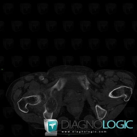 Metastasis, Ilium, CT