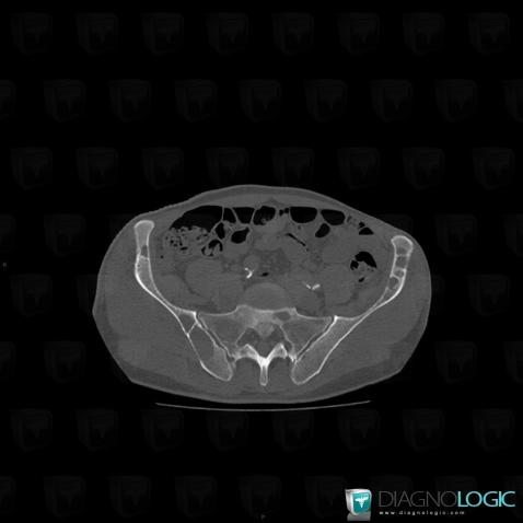 Metastasis, Ilium, CT