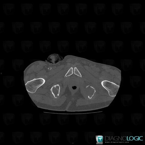 Metastasis, Ilium, CT