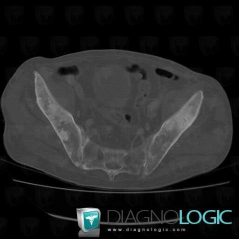 Metastasis, Ilium, CT