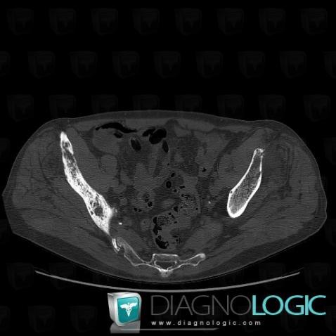 Metastasis, Ilium, CT