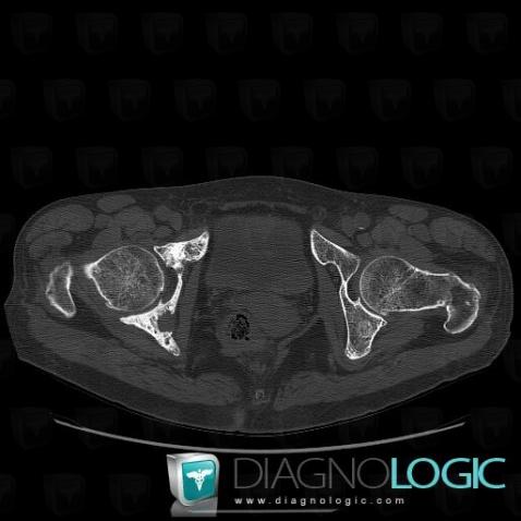 Metastasis, Ilium, CT